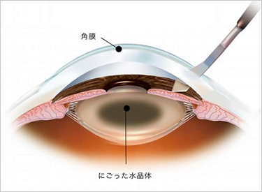白内障手術について