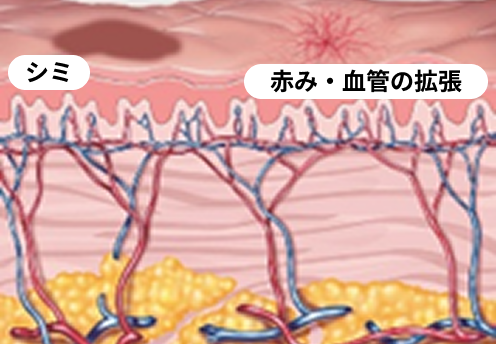 シミ 赤み・血管の拡張